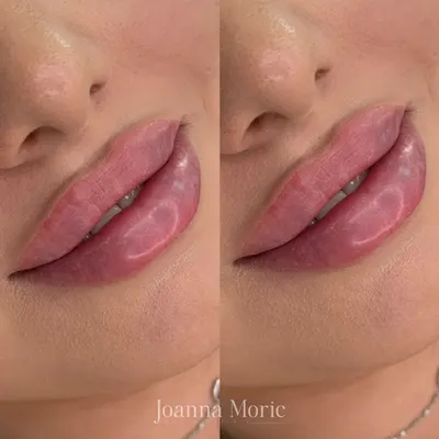 Møric Beauty Clinic Medycyna Estetyczna Kielce - Stymulatory Tkankowe | Powiększanie Ust | Mezoterapia Igłowa